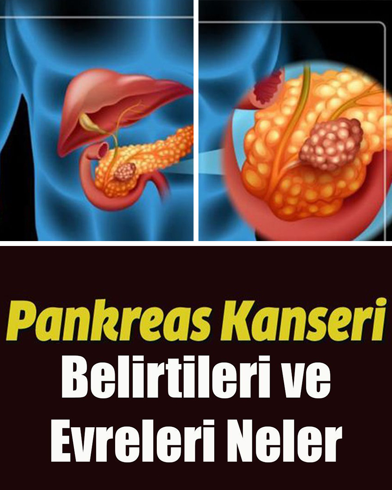 Pankreas Kanseri Belirtileri ve Evreleri Neler - 1