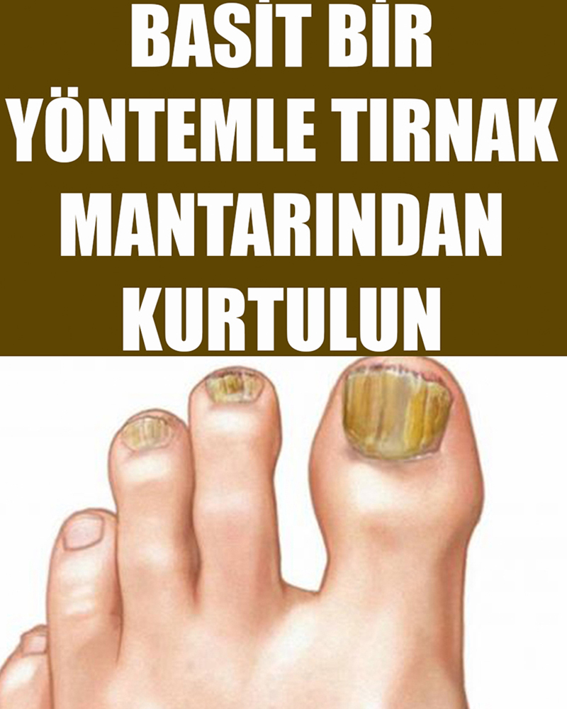 Basit Bir Yöntemle Tırnak Mantarından Kurtulun - 1