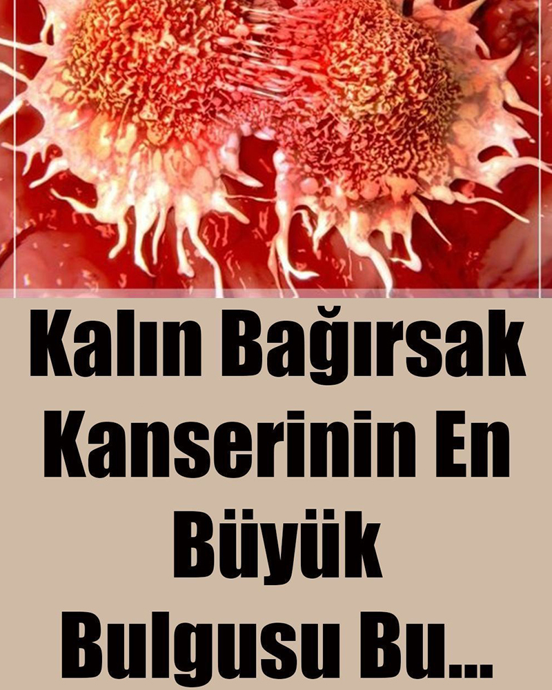 Kalın Bağırsak Kanserinin En Büyük Bulgusu - 1