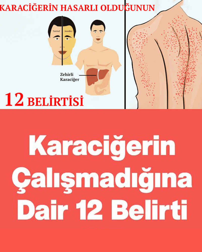 Karaciğerin Çalışmadığını Gösteren 12 Belirti - 1