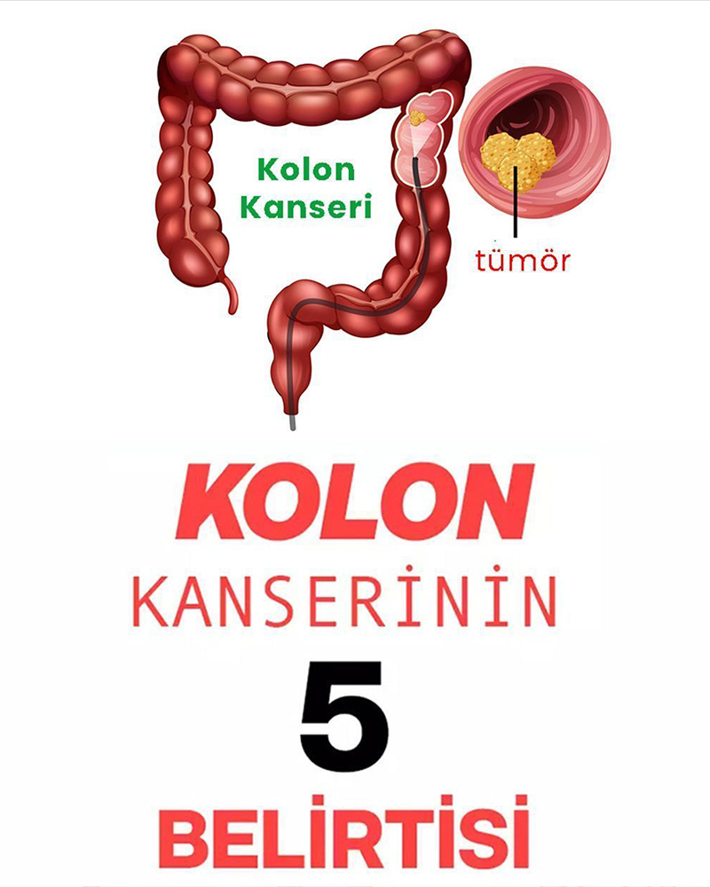 Kolon Kanserinin 5 Belirtisi - 1