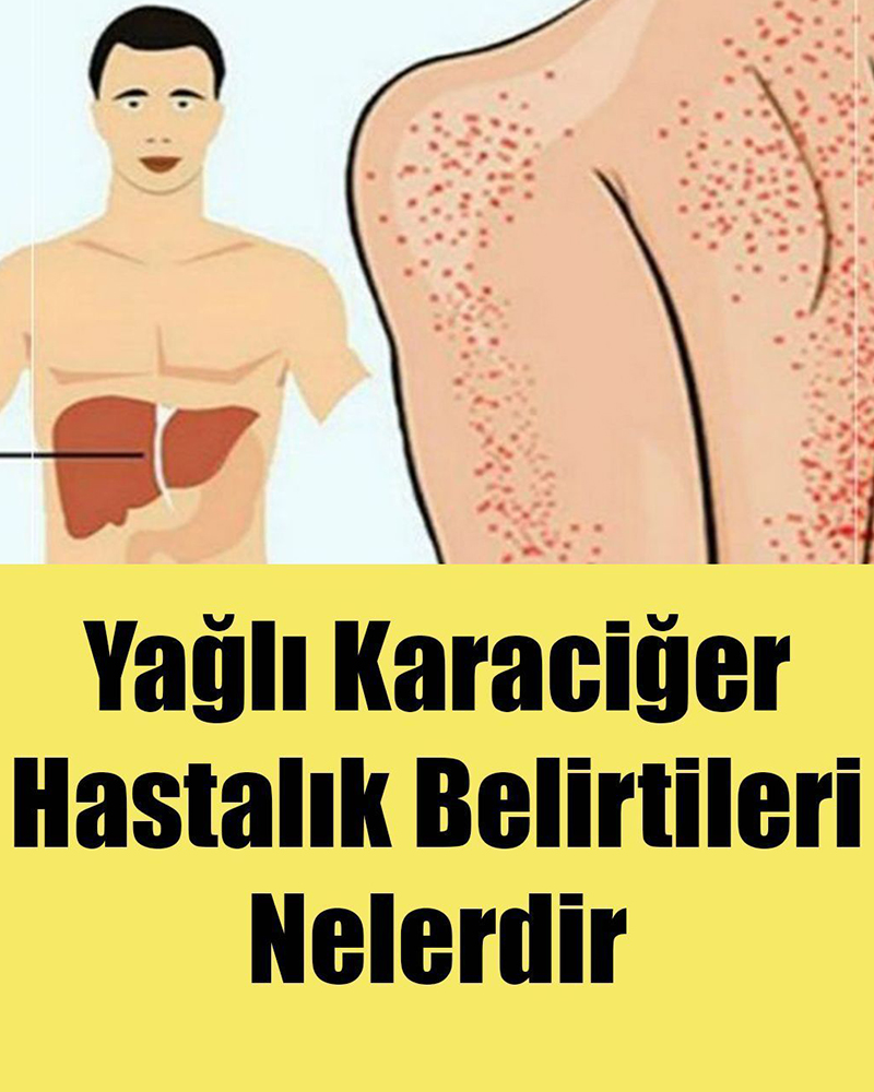 Yağlı Karaciğer Hastalığı Belirtileri - 1