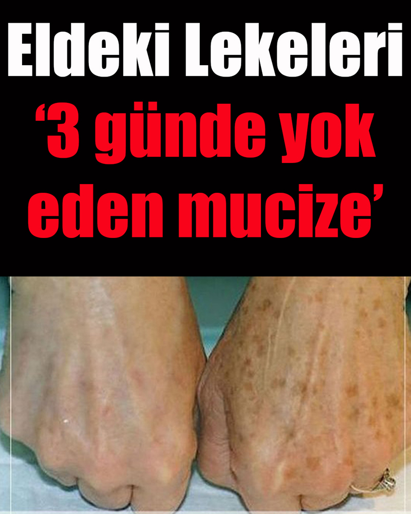 Eldeki lekeleri 3 günde yok eden mucize - 1