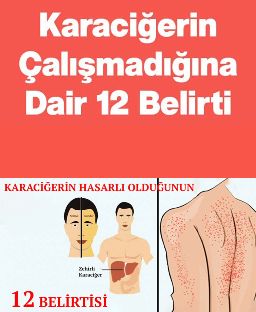 Karaciğerin Çalışmadığına Gösteren 12 Belirti - 1