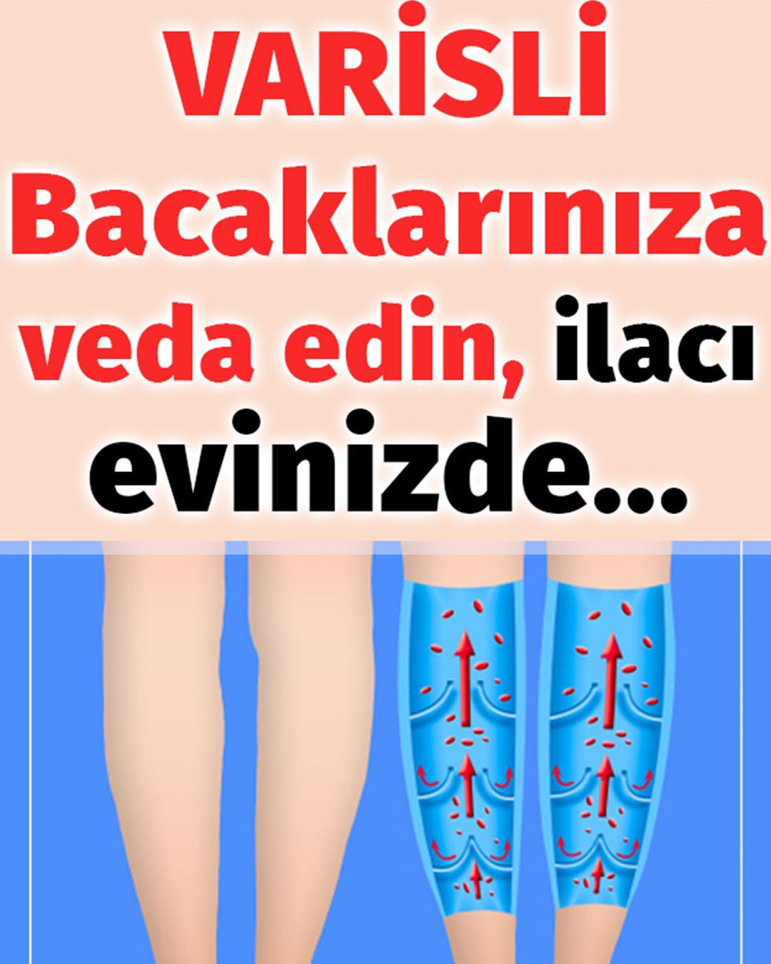 Varisli Damarlardan Kurtulmak İçin Doğal Çözümler - 1