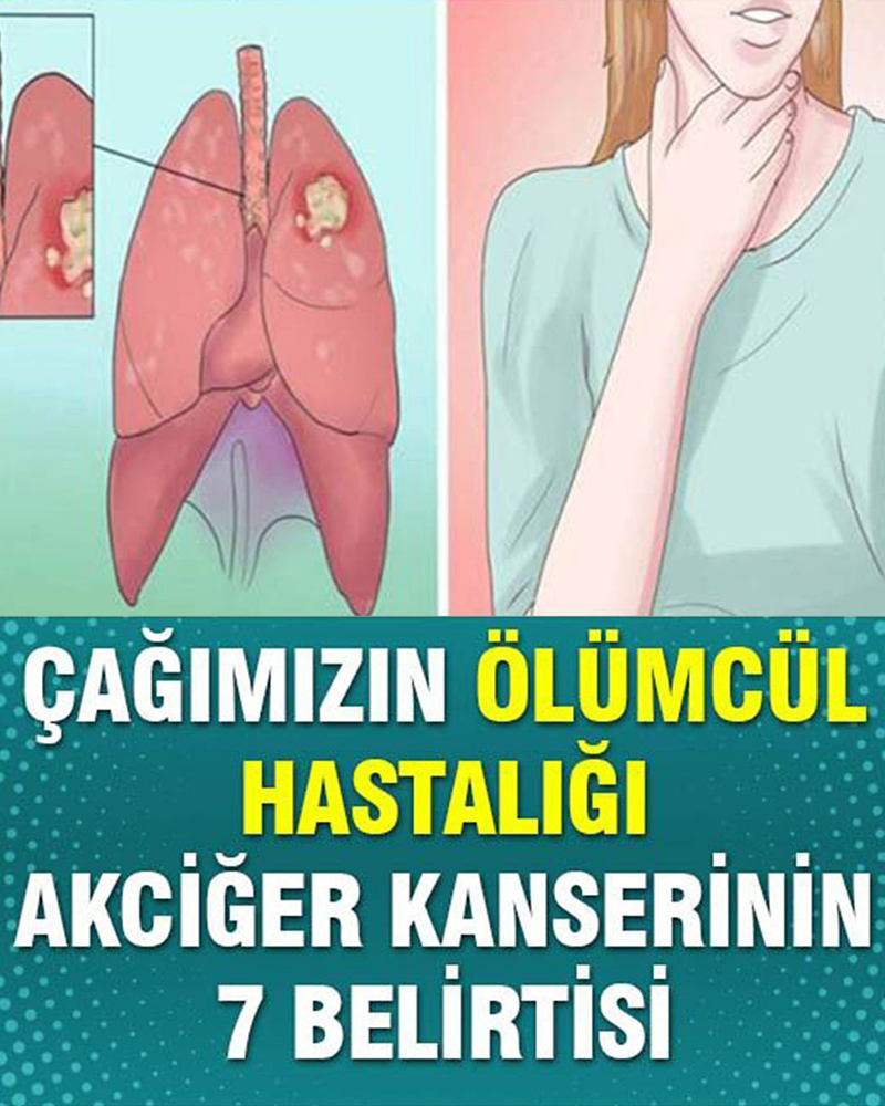 Çağın Hastalığı Akciğer Kanserinin 7 Belirtisi - 1
