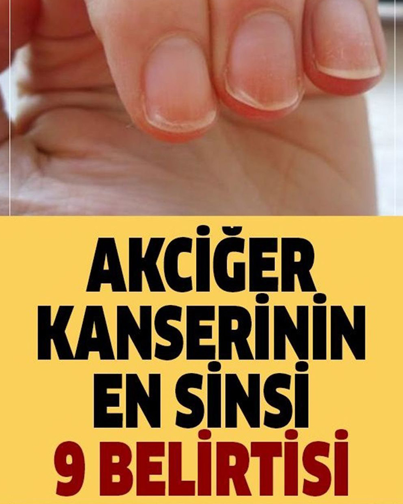 Akciğer Kanserinin En Sinsi 9 Bulgusu - 1