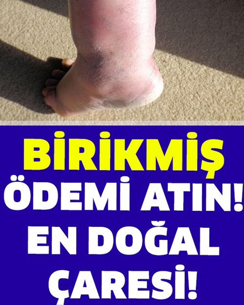 Bedeninizdeki Birikmiş Ödemi Atmak Ne Kadar Faydalı? - 1