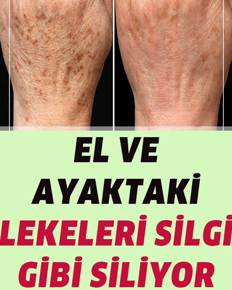 El ve Ayaktaki Lekeleri Silgi Gibi Siliyor - 1