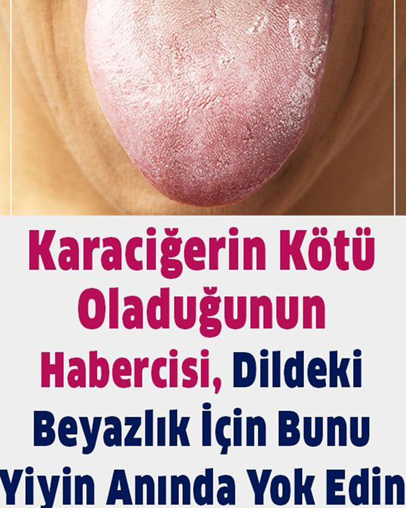 Karaciğerinizin kötü olduğuna işaret eden dildeki beyazlığı bitiren yöntem - 1