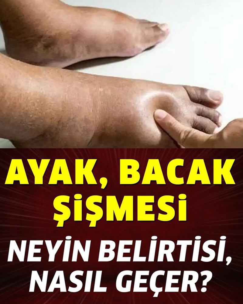 Ayak Bacak Şişmesi Neyin Belirtisi - 1