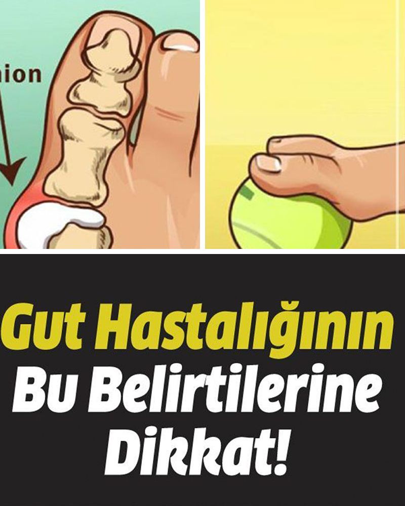 Gut Hastalığının Belirtilerine Dikkat - 1