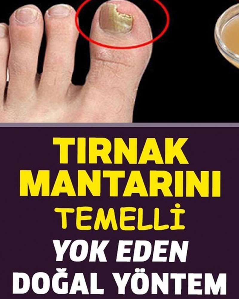 Tırnak Mantarını Temelli Yok Eden Doğal Yöntem - 1