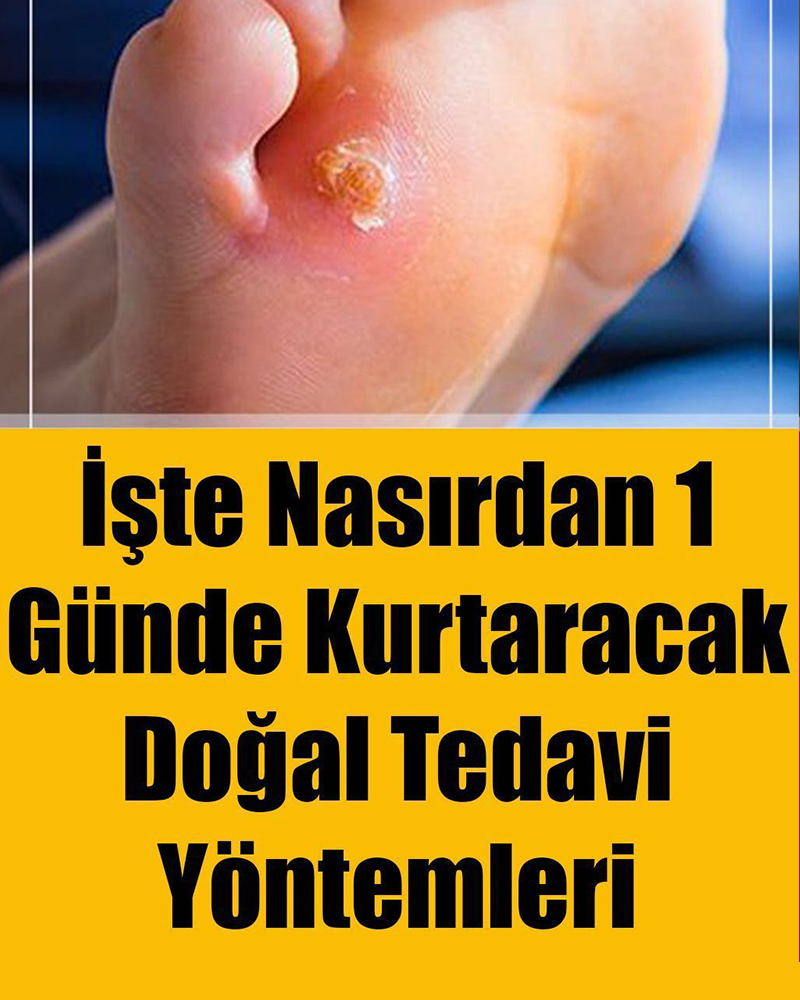 İşte Nasırdan 1 Günde Kurtaracak Doğal Tedavi Yöntemleri - 1