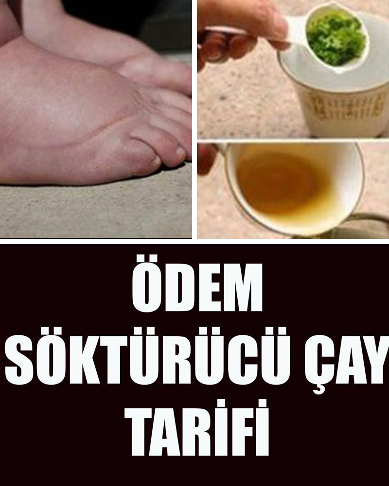 Ödem Söktürücü Çay Tarifi - 1