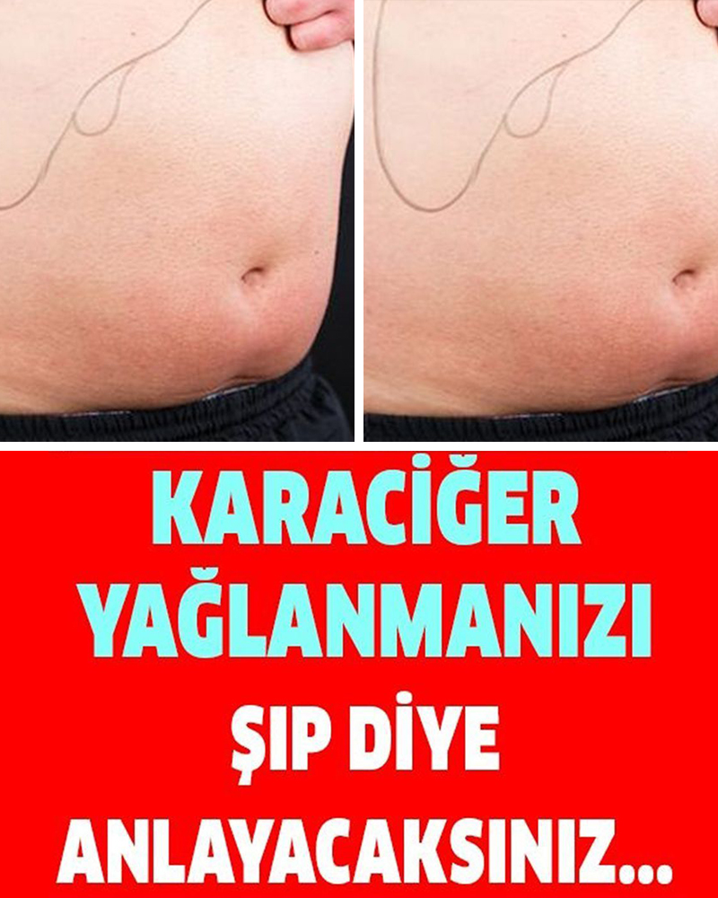 Karaciğer Yağlanması Nasıl Anlaşılır - 1