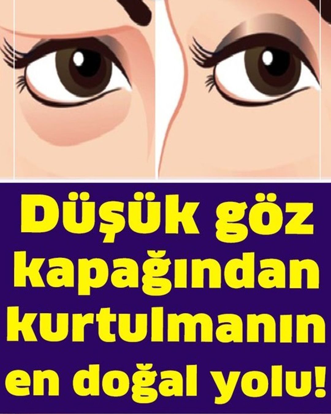 Bu Yöntemi Uygulayanlar Düşük Göz Kapağından Kurtulur - 1