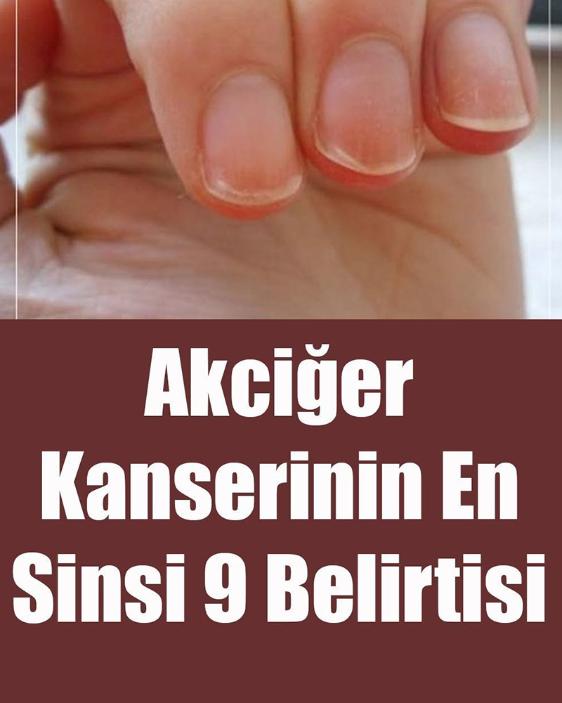 Akciğer Kanserinin En Sinsi 9 Belirtisi - 1