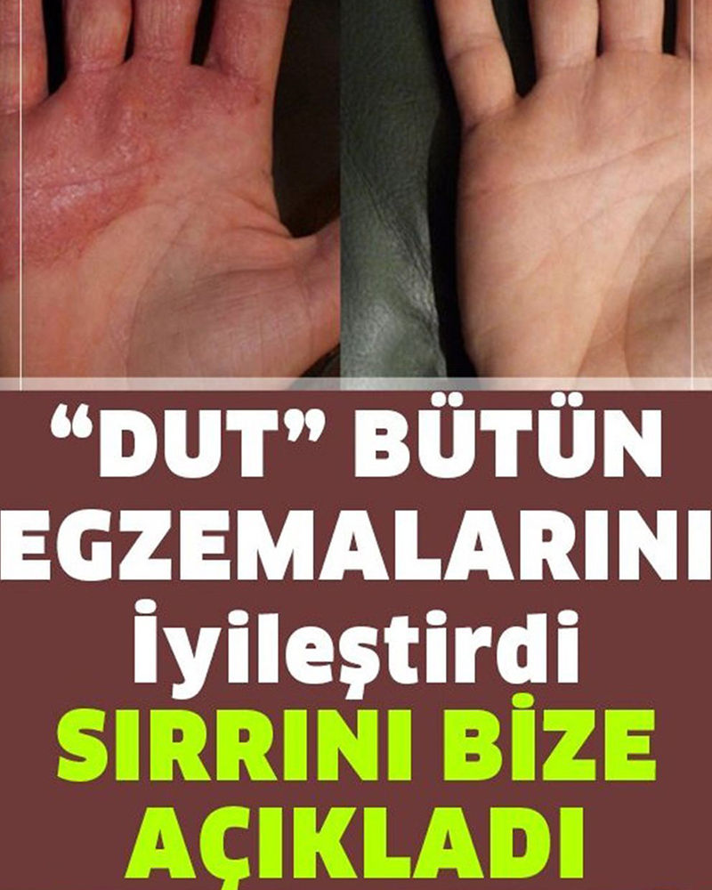 Egzamadan Kurtaran En İyi Doğal Tedavi - 1