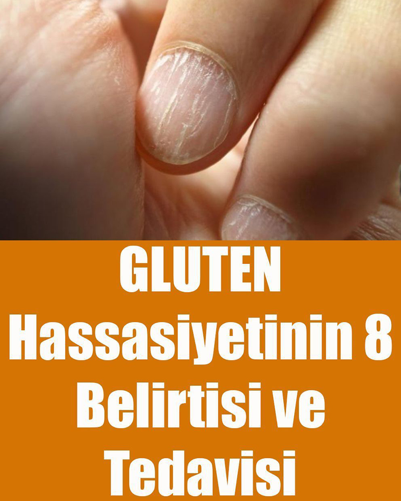 Gluten Hassasiyetinin 8 Belirtisi ve Tedavisi - 1