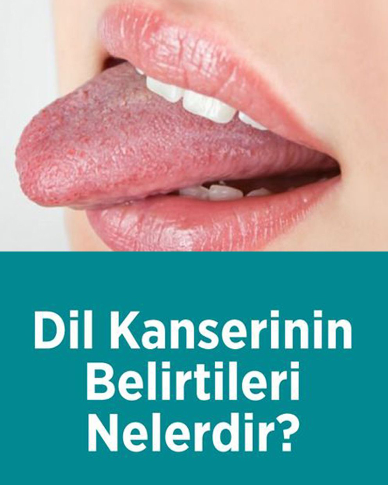 Dil kanserinin belirtileri - 1