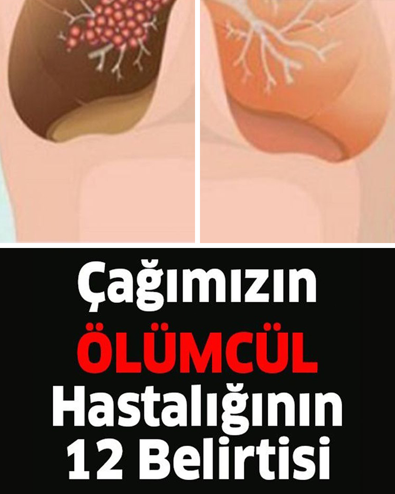 Çağın Hastalığı Akciğer Kanserinin Belirtileri - 1