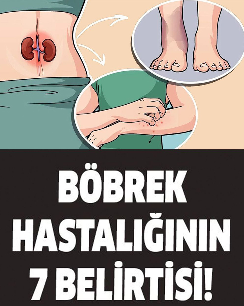Böbrek Hastalığının 7 Belirtisi - 1