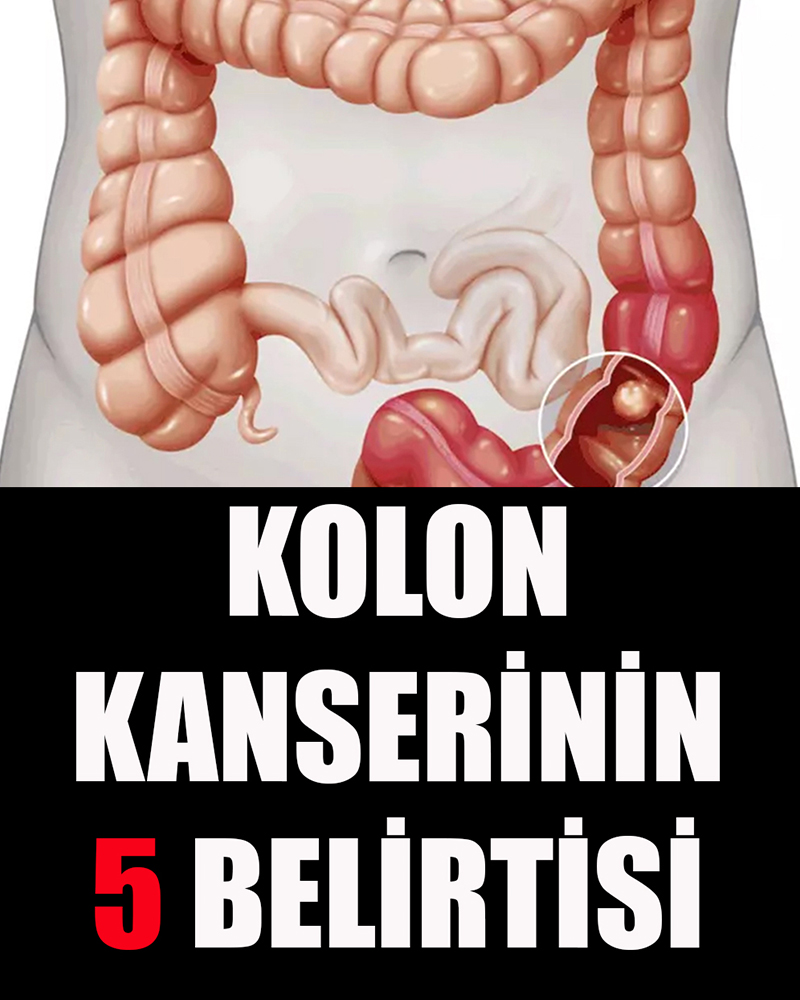 Kolon Kanserinin 5 Belirtisi - 1