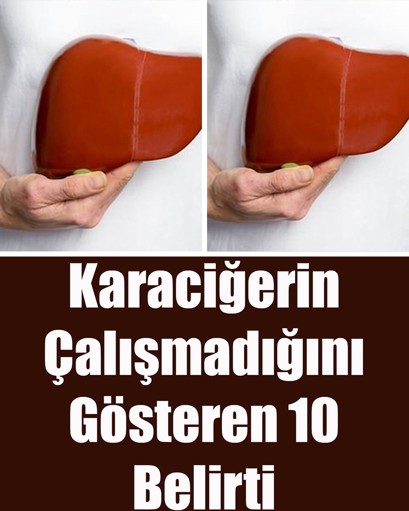 Karaciğerin Çalışmadığına Dair 12 Belirti - 1