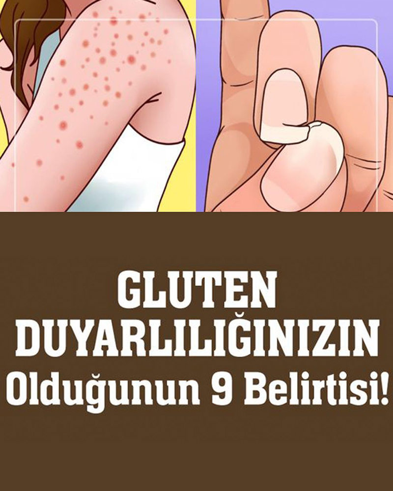 Gluten Hassasiyetinin 9 Belirtisi ve Tedavisi - 1