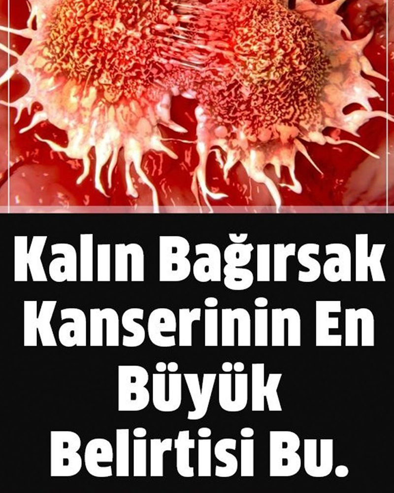 Kalın Bağırsak Kanserinin En Büyük Bulgusu - 1