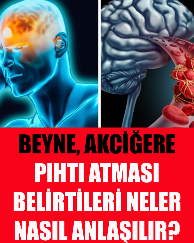 Pıhtı Atması Belirtileri Nelerdir - 1