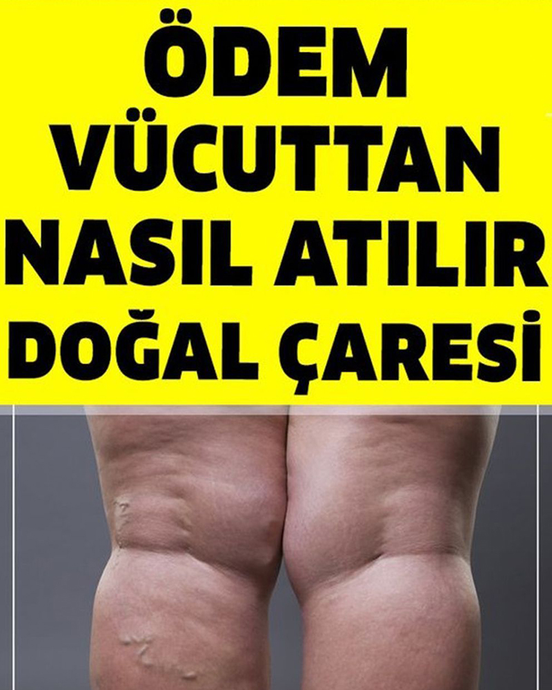 Vücudunuzdaki Birikmiş Ödemi Atmanın Doğal Çaresi - 1