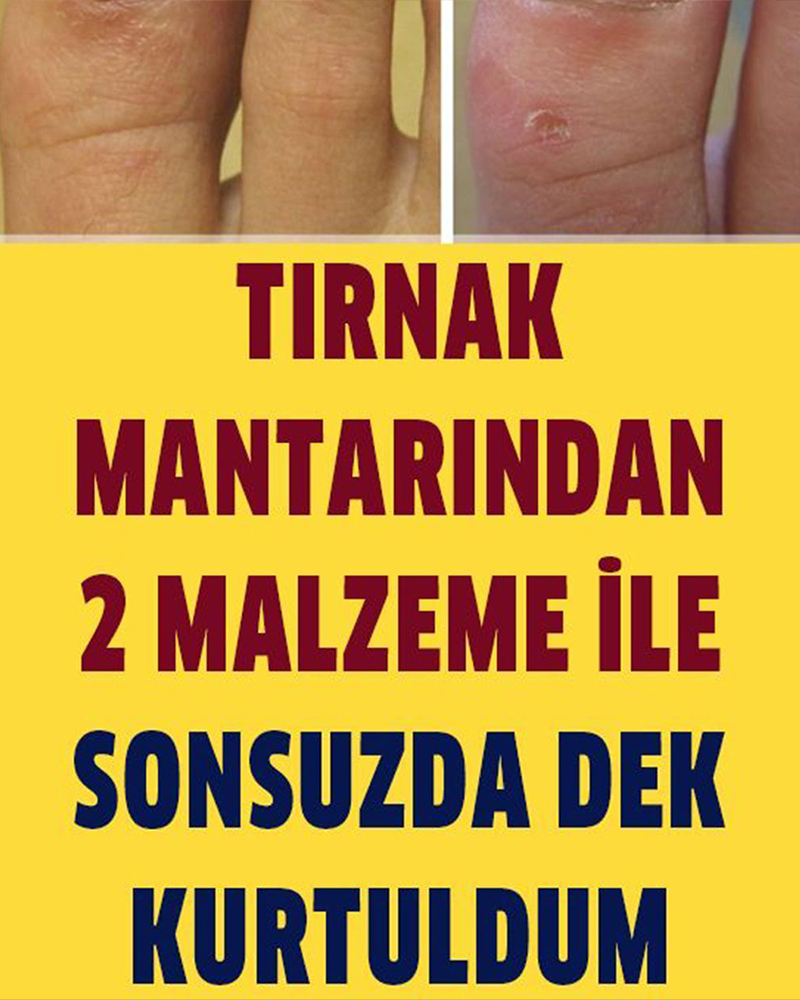 Sonsuza Dek Tırnak Mantarından Kurtulun 2 Malzemeli Tarif - 1