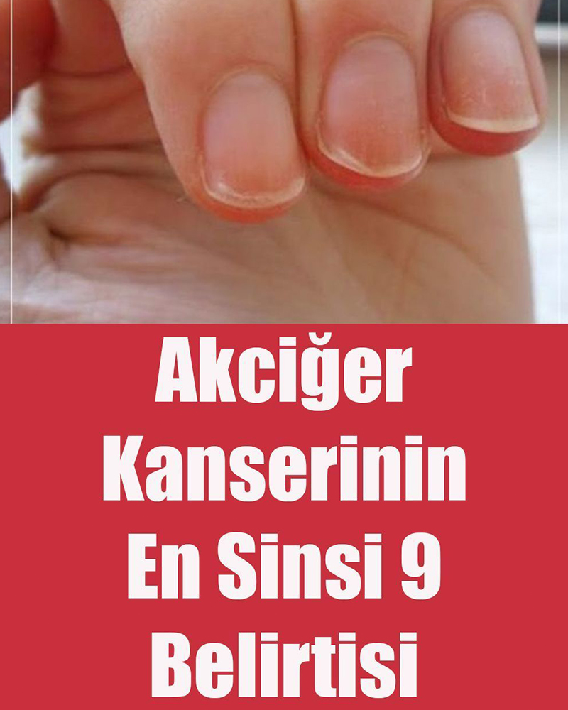 Akciğer Kanserinin En Sinsi 9 Belirtisi - 1