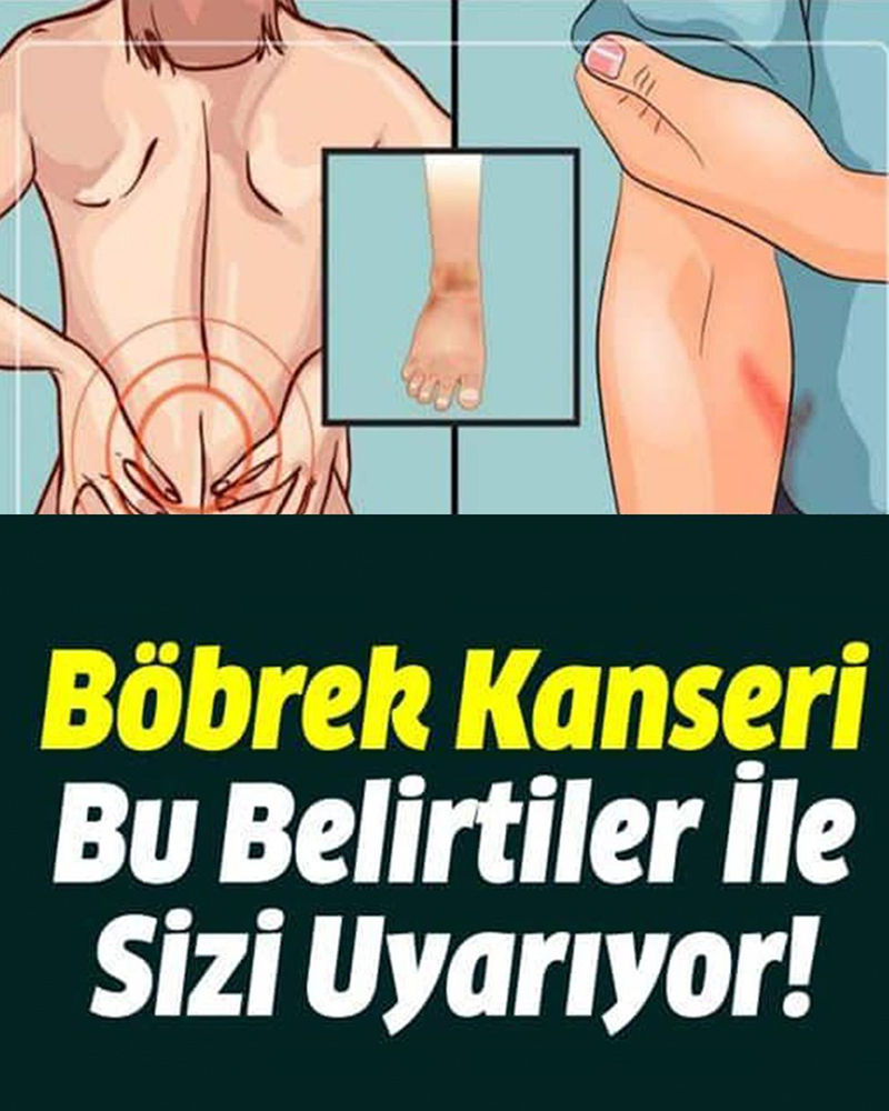Böbrek Kanseri Bu Belirtiler İle Sizi Uyarıyor - 1