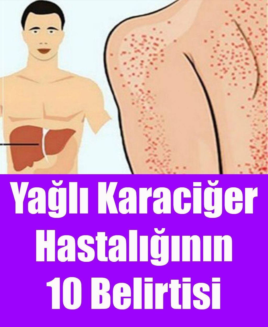 Yağlı Karaciğer Hastalığının 10 Belirtisi - 1