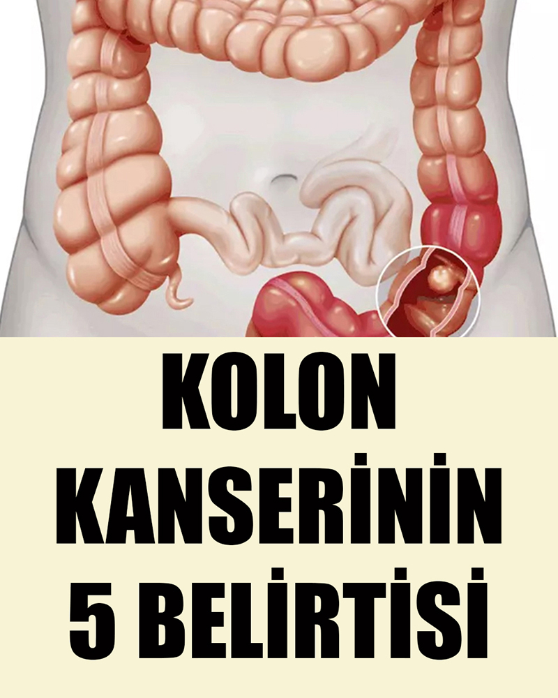 Kolon Kanserinin 5 Belirtisi - 1
