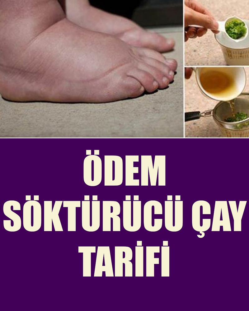 Ödem Söktürücü Çay Tarifi - 1