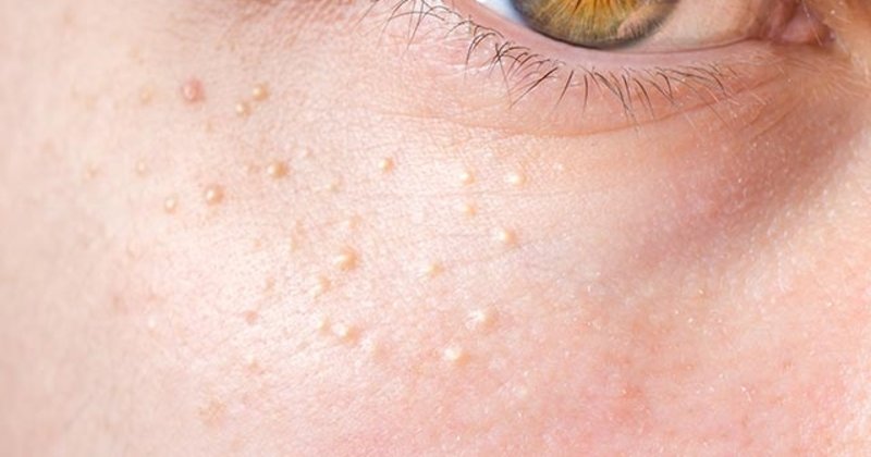 Yağ Bezelerini Geçirmenin En Etkili Yolları - 4