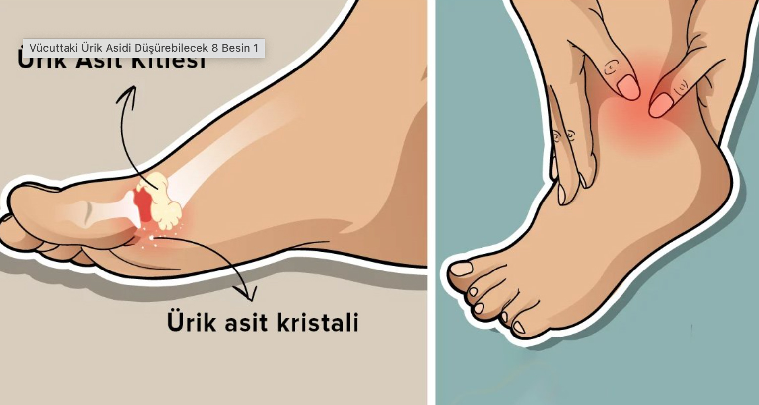 Ayaklardaki Ağrının Sebebi Ürik Asit Olabilir - 4