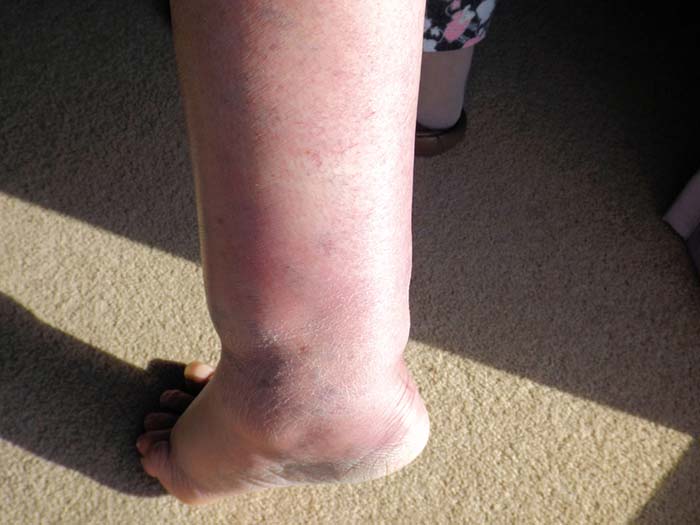 Bedeninizdeki Birikmiş Ödemi Atmak Ne Kadar Faydalı? - 2