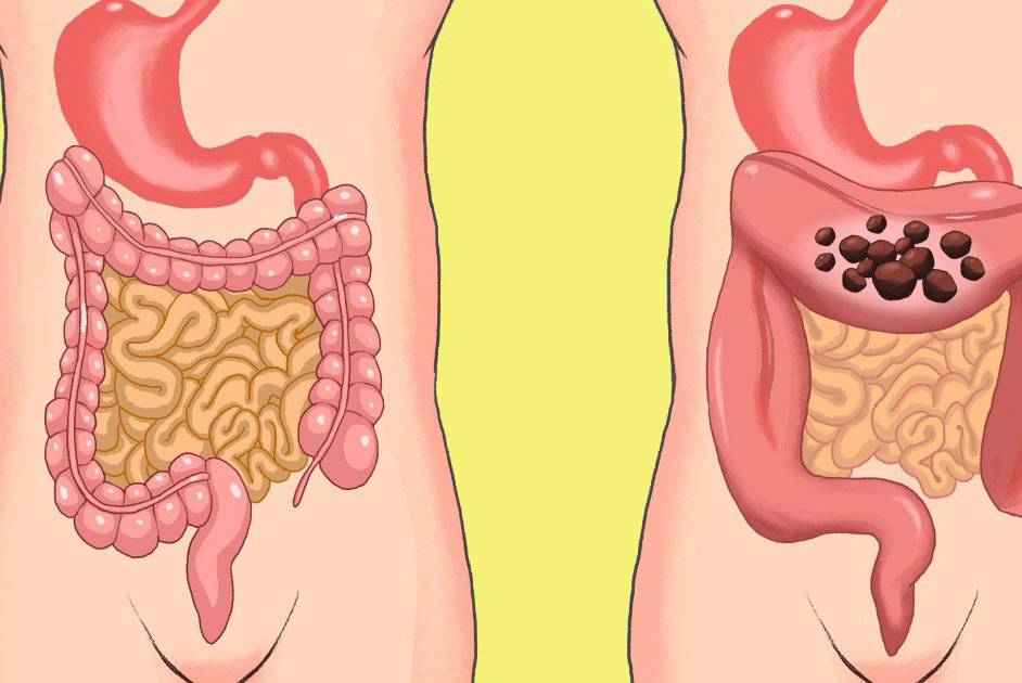 Bağırsakları Tertemiz Yapmanın Yedi Yolu - 4