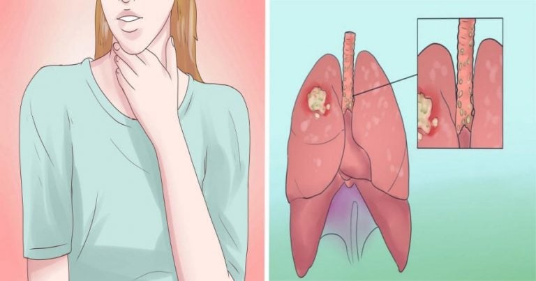 Çağın Hastalığı Akciğer Kanserinin Belirtileri - 2