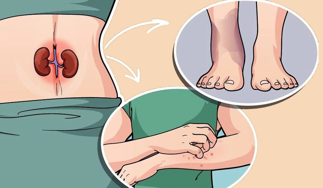 Böbrek Hastalığının 8 Belirtisi - 3