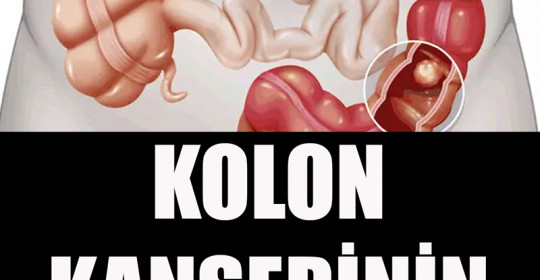 Kolon Kanserinin 5 Belirtisi