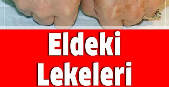 Eldeki lekeleri 3 günde yok eden mucize	
