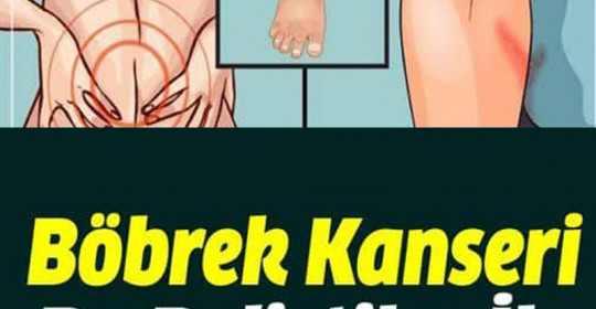 Böbrek Kanseri Bu Belirtiler İle Sizi Uyarıyor