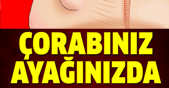 Çorabınız Ayağınızda İz Bırakıyorsa Dikkat