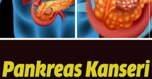 Pankreas Kanseri Belirtileri ve Evreleri Neler	
